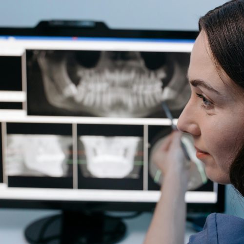 Cosa sono i denti del giudizio